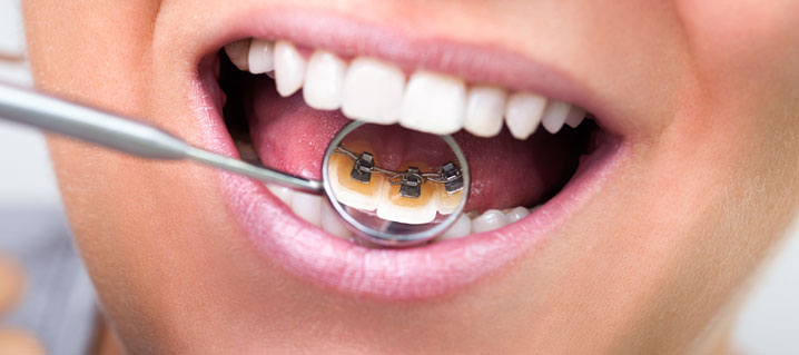 What are lingual braces? 